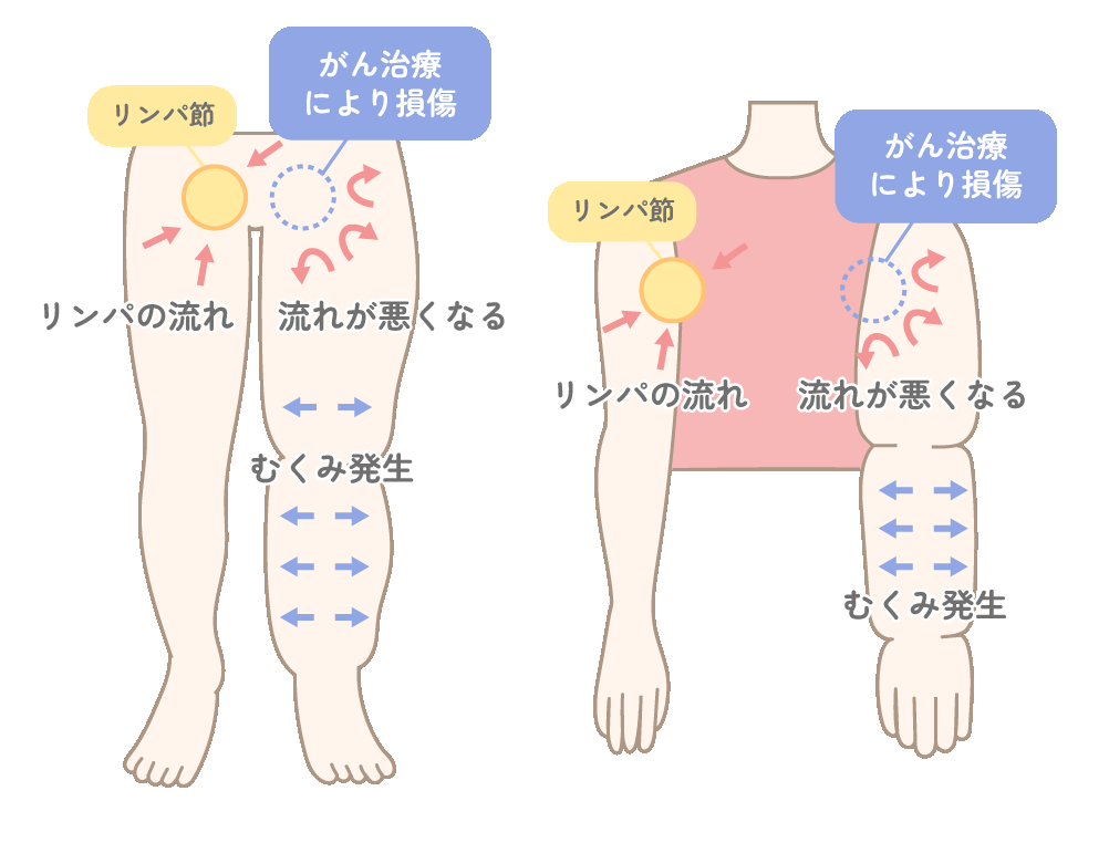 がん治療によるリンパ節やリンパ管の損傷でリンパの流れが悪くなり、腕や脚にむくみが生じるリンパ浮腫の仕組みを示したイラスト