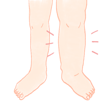 リンパの流れが滞ることで起こる慢性的な足のむくみを示すイラスト